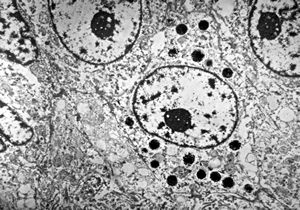 F,72y. | melanoblastoma oculi F,72y. | melanoblastoma oculi